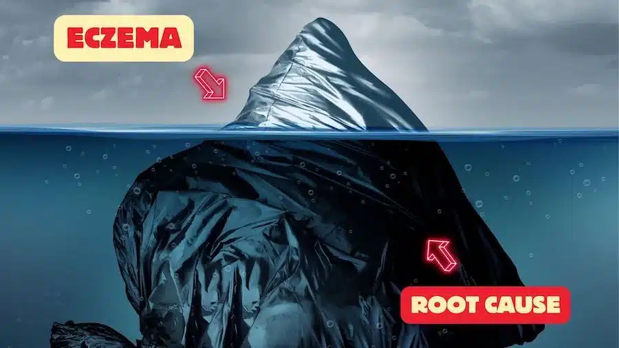 How I Cured Eczema Naturally and Permanently